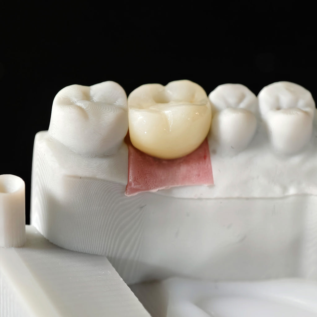 Zirconia Crown With Screw Retained