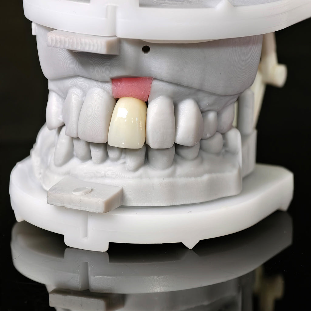 Zirconia Crown With Screw Retained