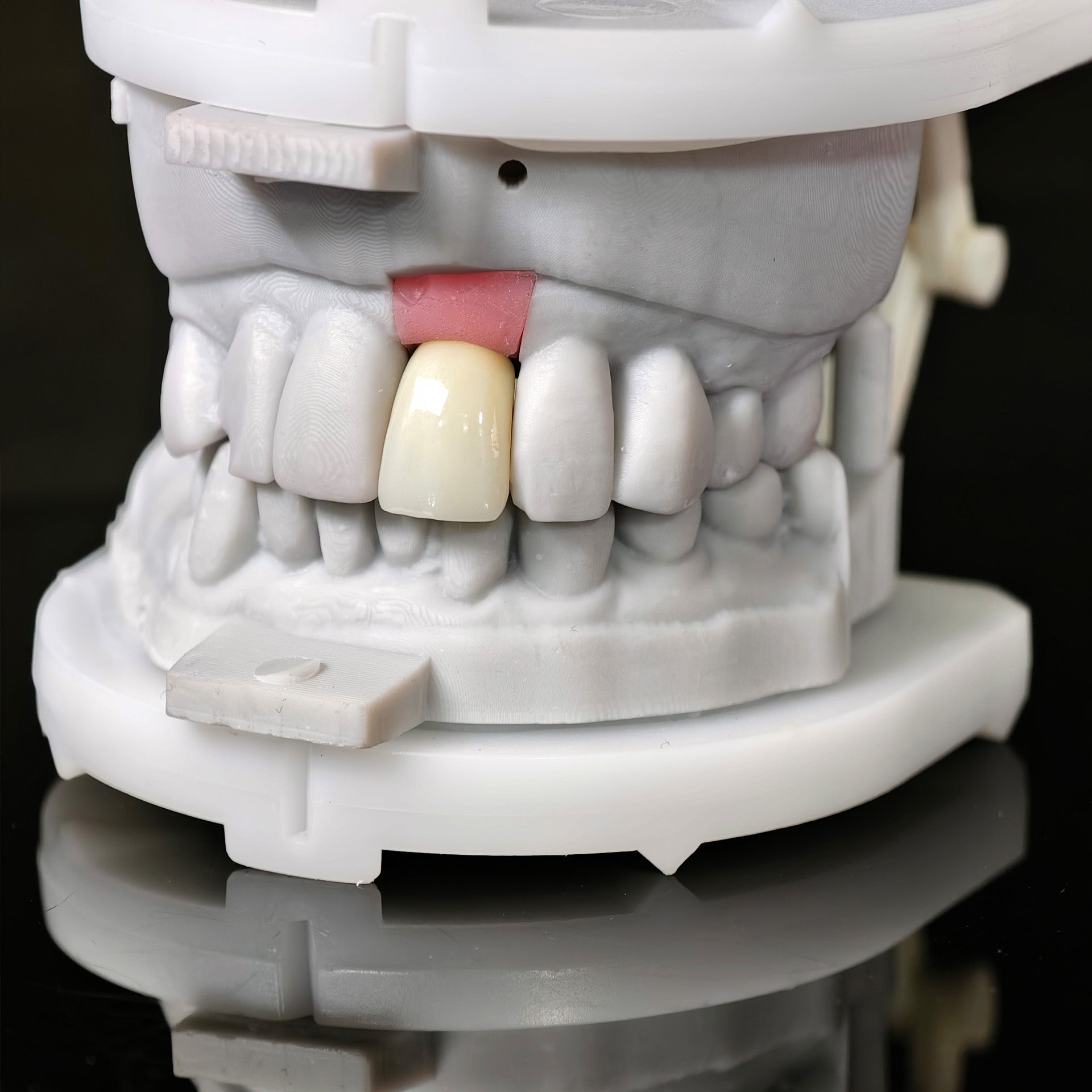 Zirconia Crown With Screw Retained