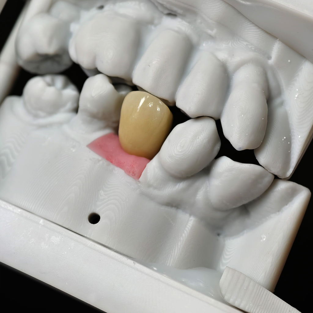 Zirconia Crown With Screw Retained