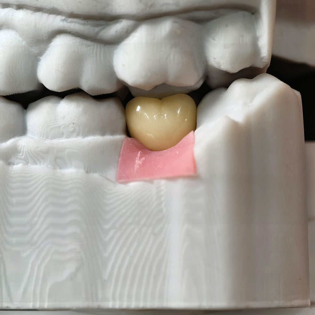 Zirconia Crown With Screw Retained