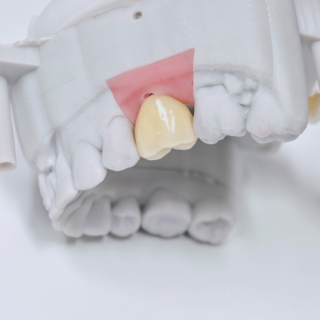 Zirconia Crown With Screw Retained