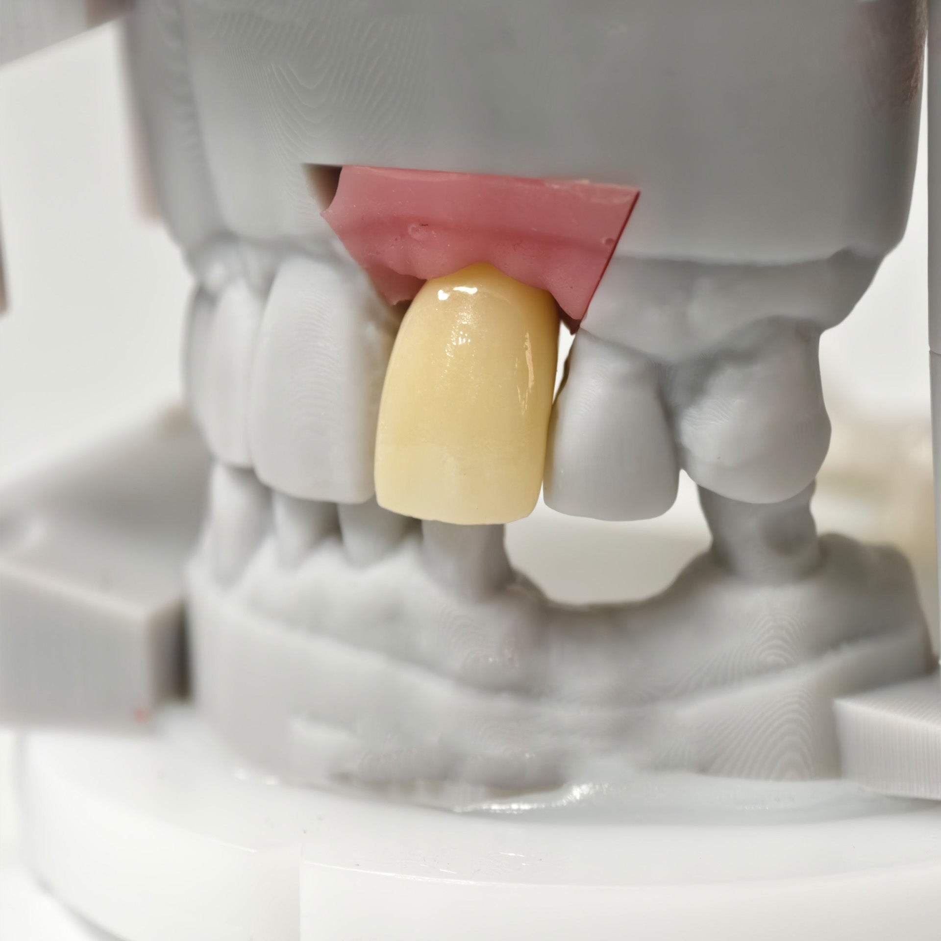 Zirconia Crown With Screw Retained