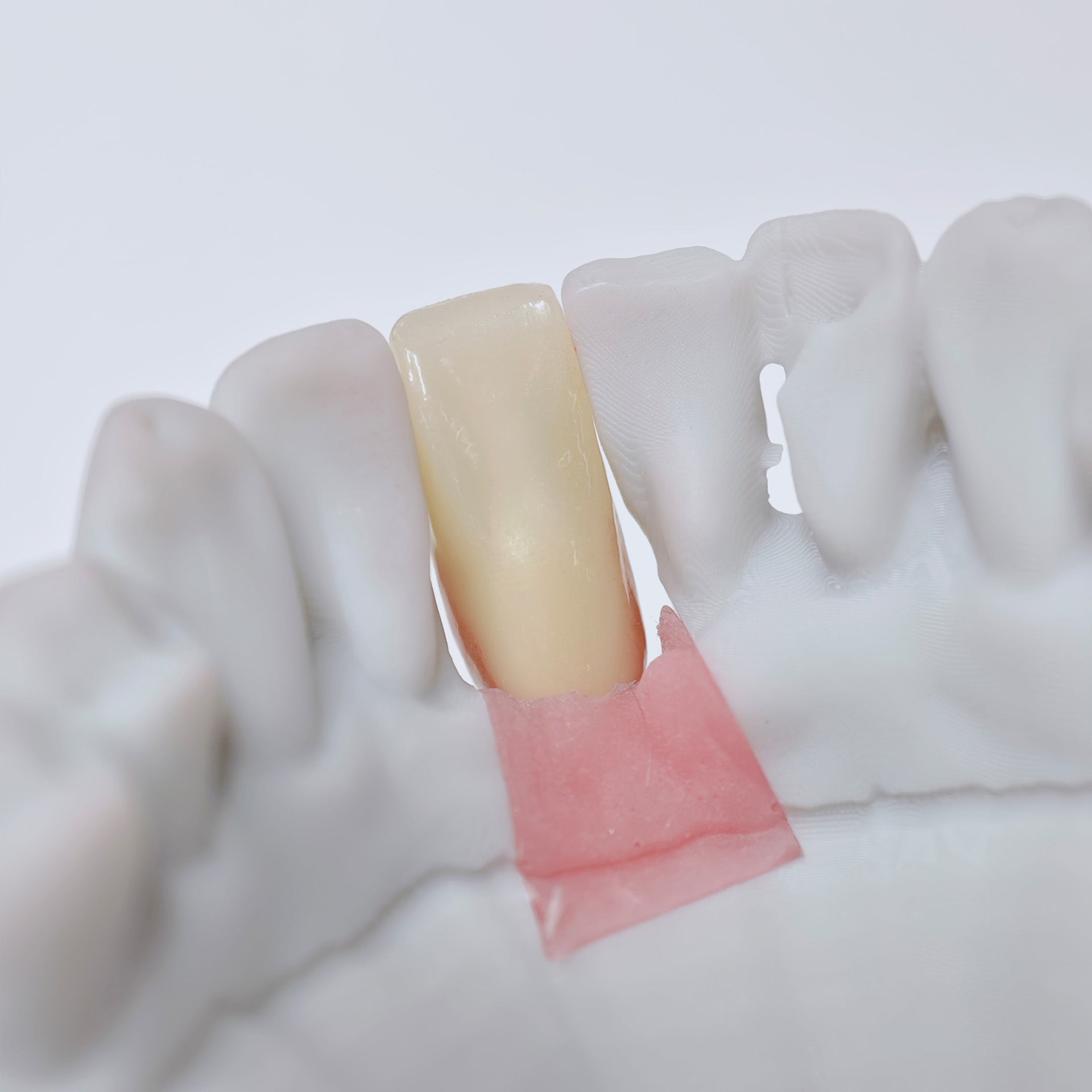 Zirconia Crown With Screw Retained