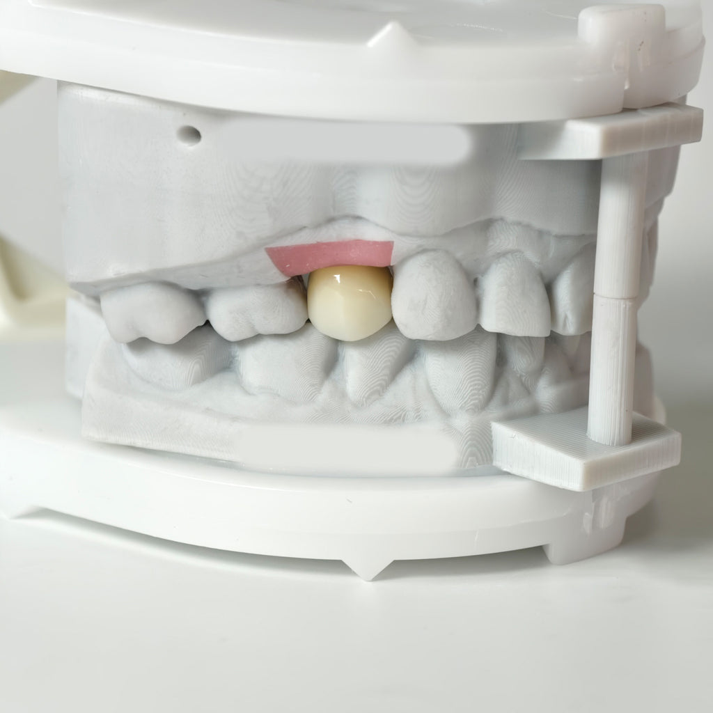 Zirconia Crown With Screw Retained