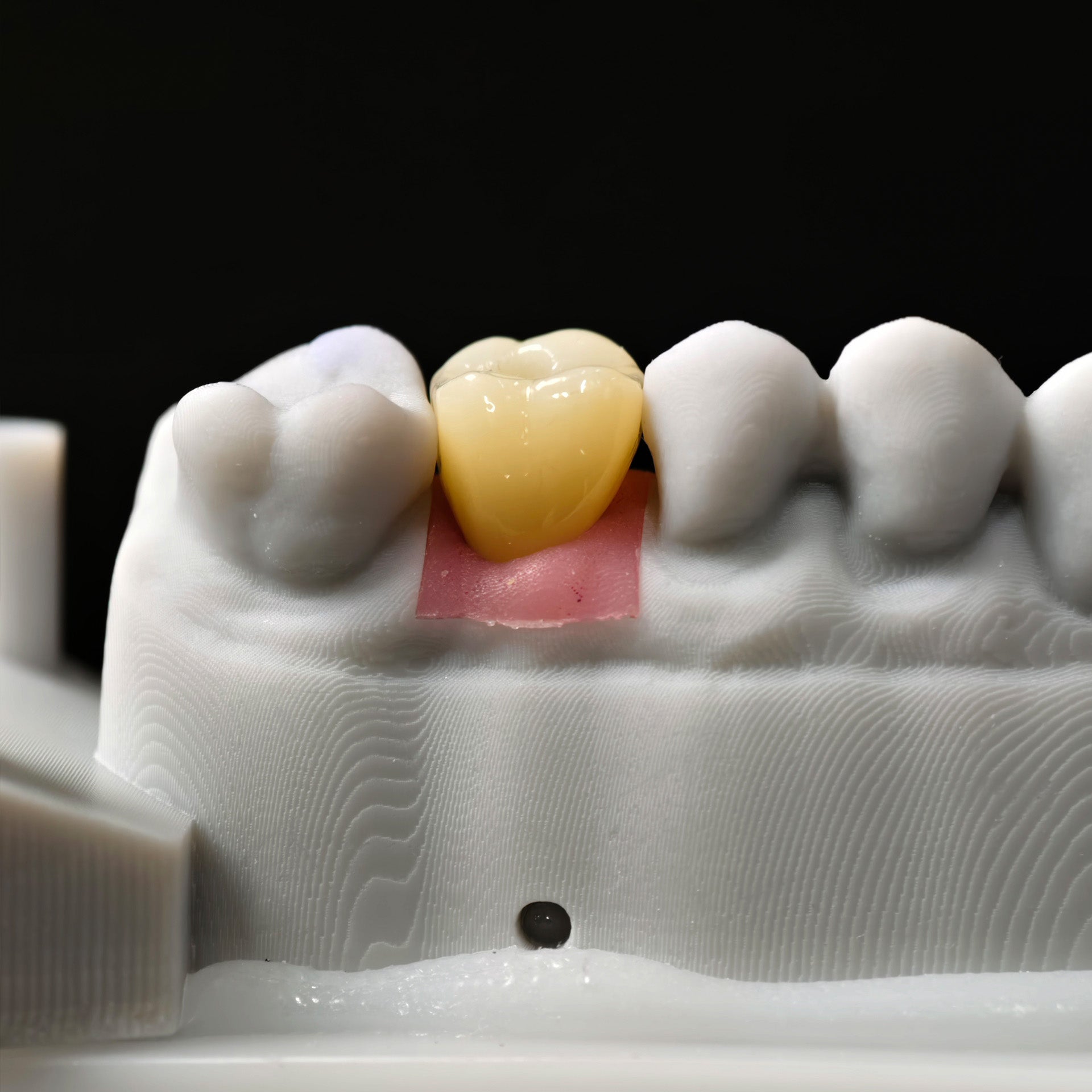 Zirconia Crown With Screw Retained