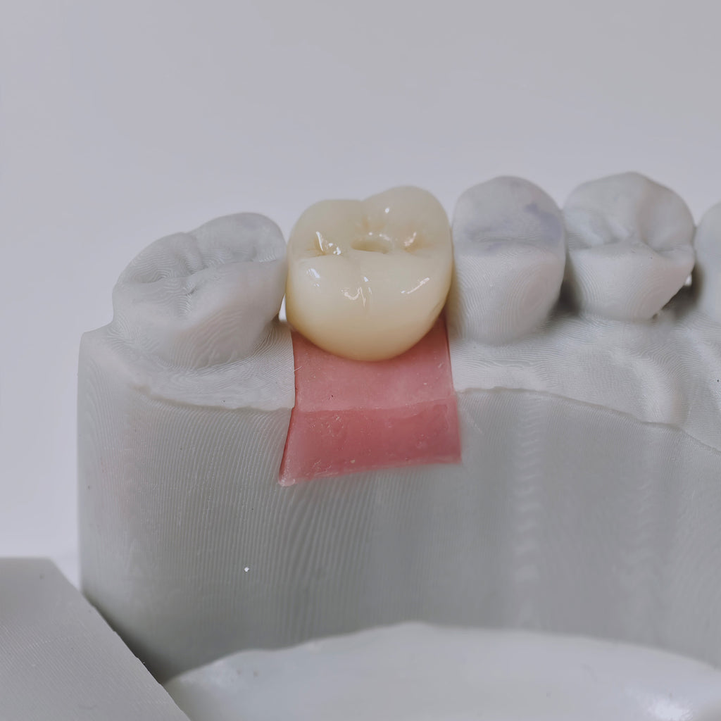 Zirconia Crown With Screw Retained