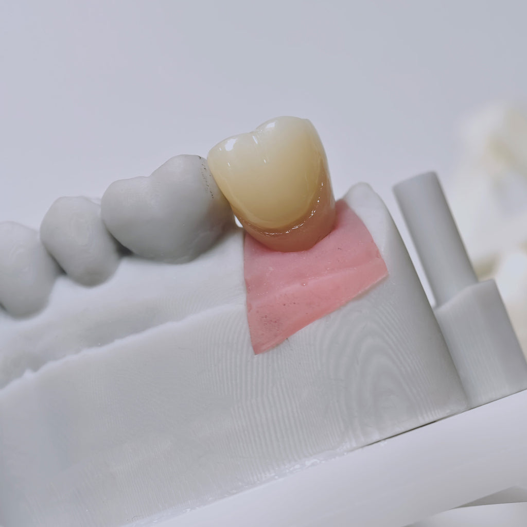 Zirconia Crown With Screw Retained