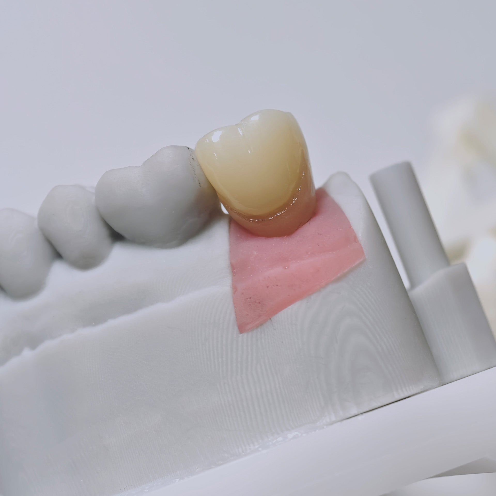 Zirconia Crown With Screw Retained