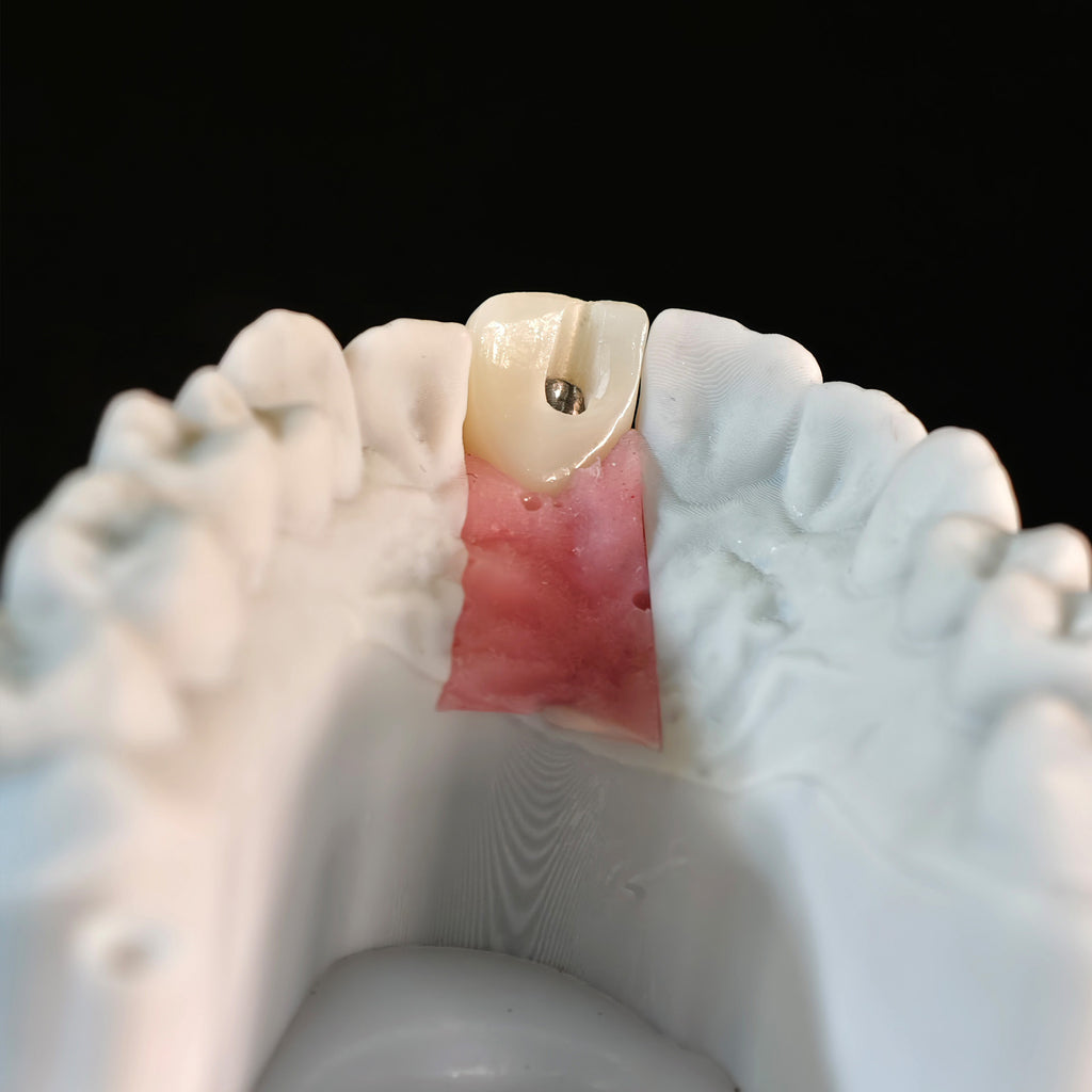 Zirconia Crown With Screw Retained