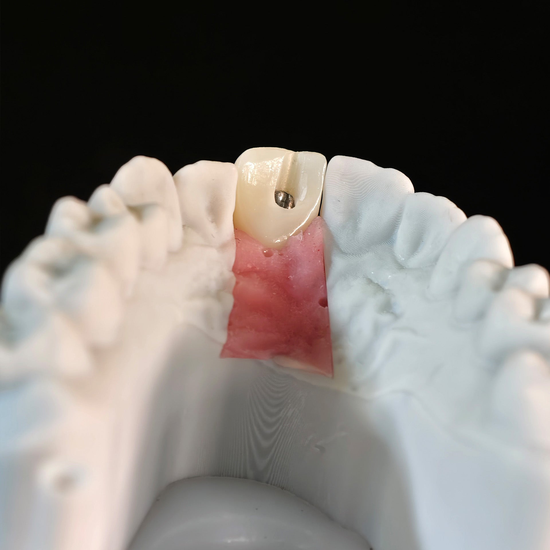 Zirconia Crown With Screw Retained