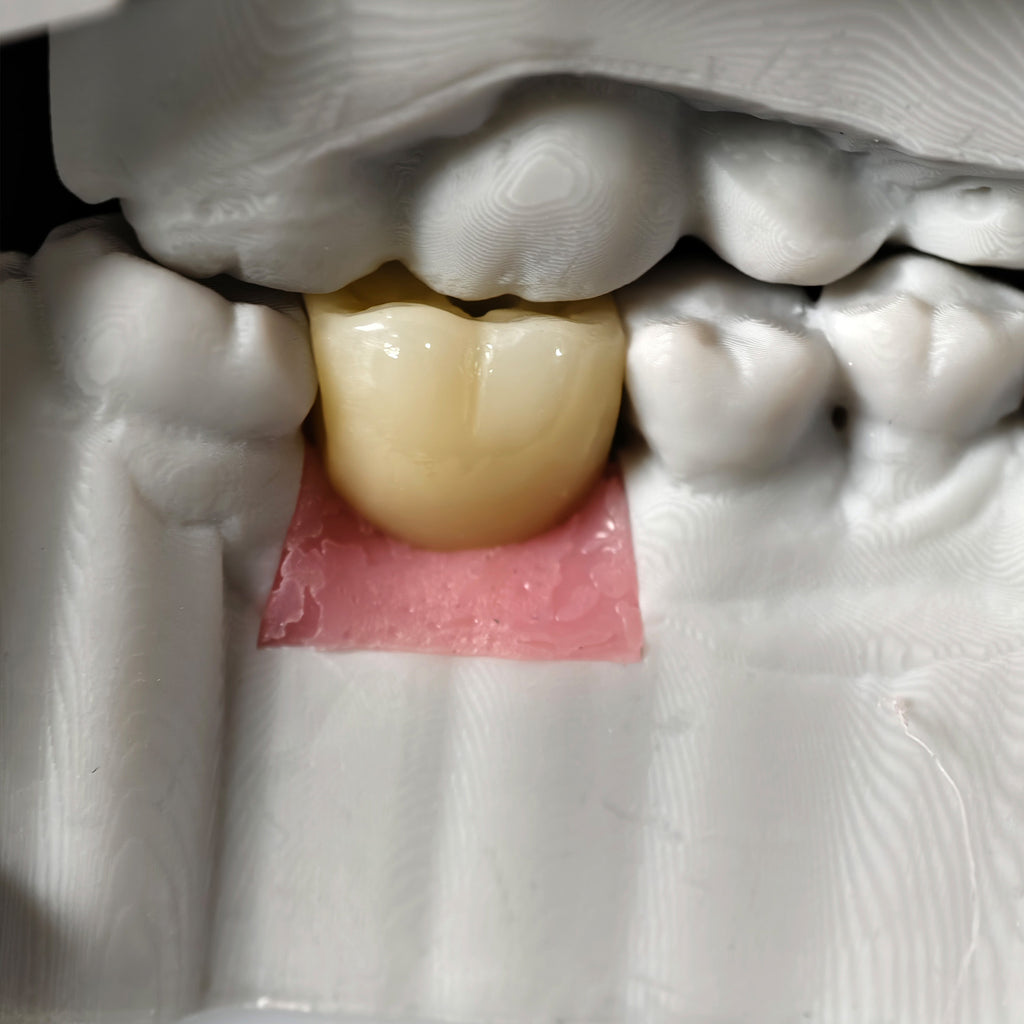 Zirconia Crown With Screw Retained