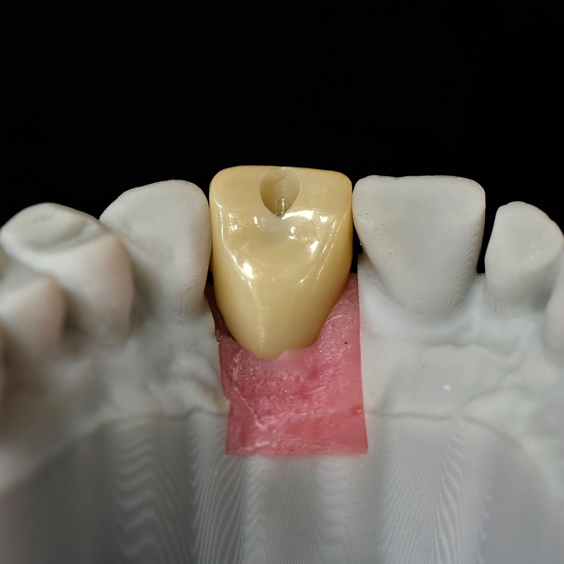 Zirconia Crown With Screw Retained