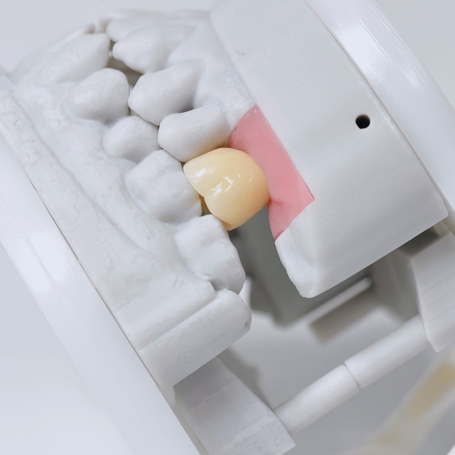 Zirconia Crown With Screw Retained