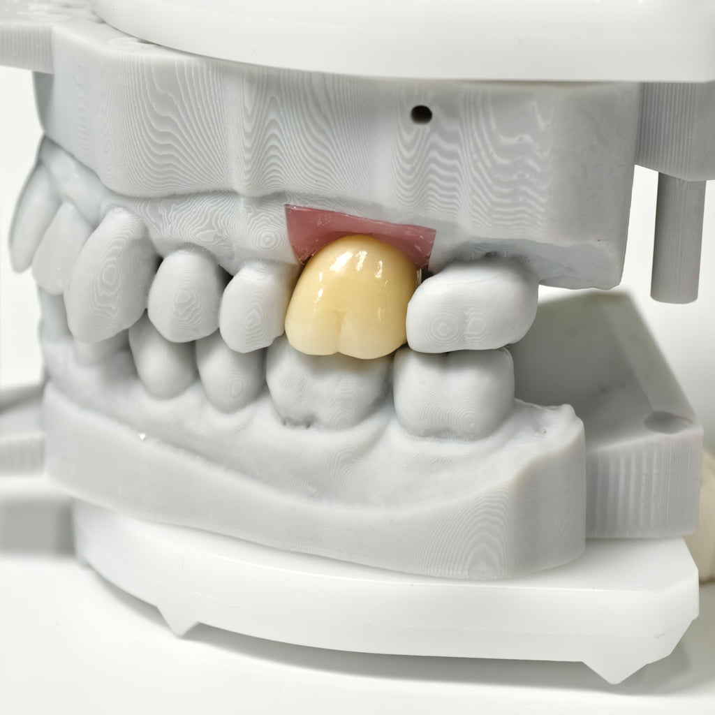 Zirconia Crown With Screw Retained