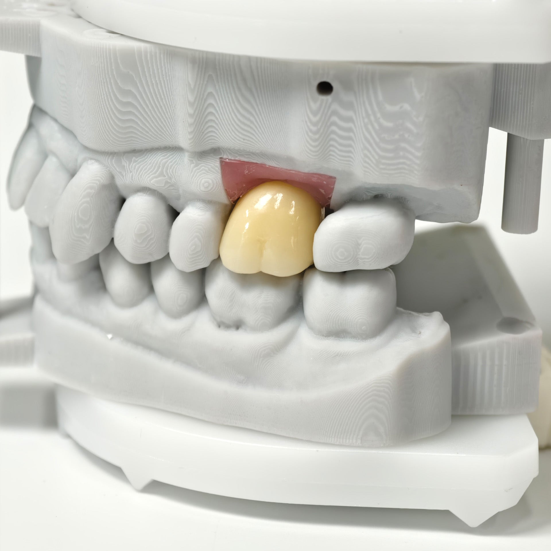 Zirconia Crown With Screw Retained