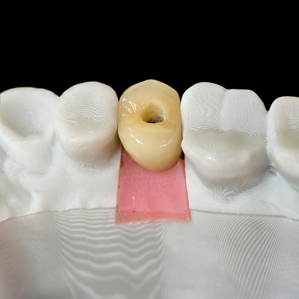 Zirconia Crown With Screw Retained
