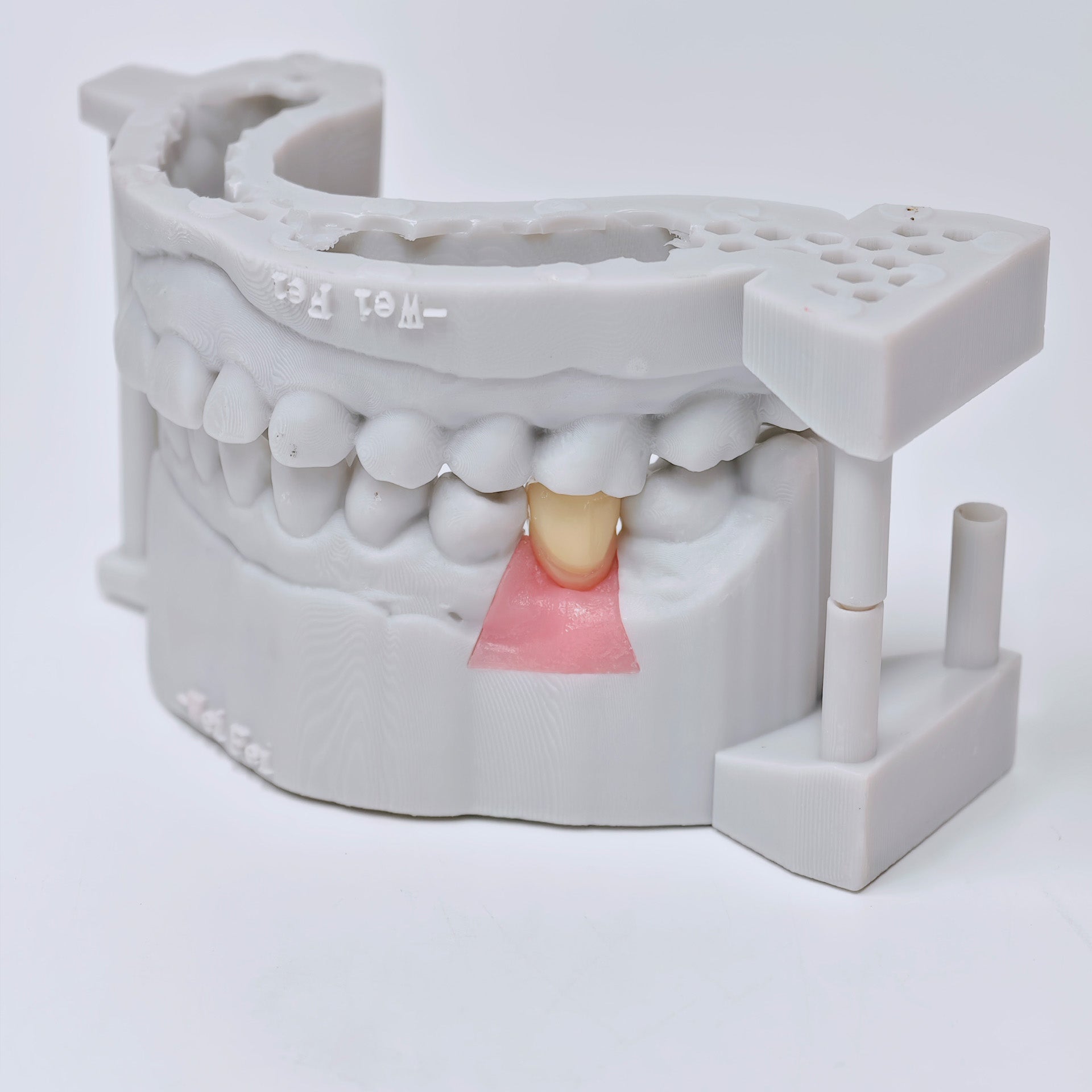 Zirconia Crown With Screw Retained