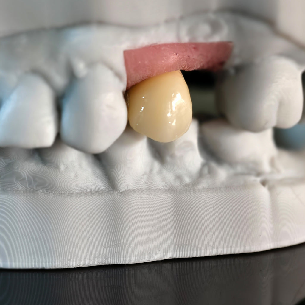 Zirconia Crown With Screw Retained