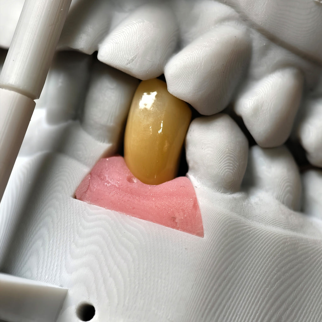 Zirconia Crown With Screw Retained