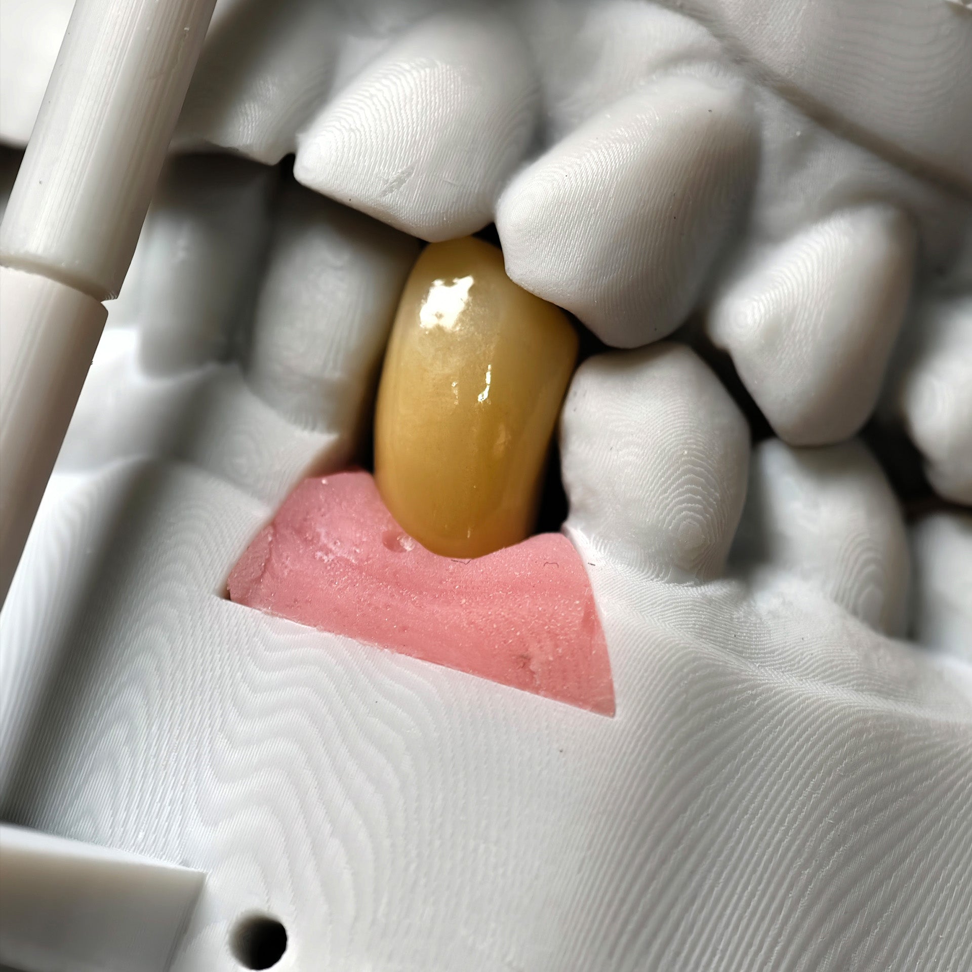 Zirconia Crown With Screw Retained