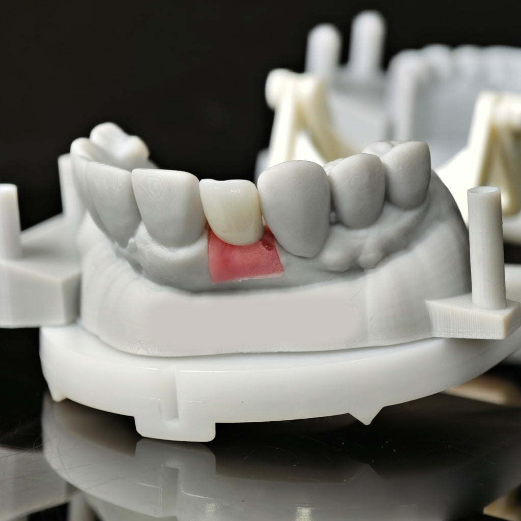 Zirconia Crown With Screw Retained