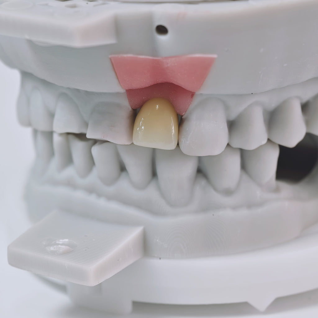 Zirconia Crown With Screw Retained