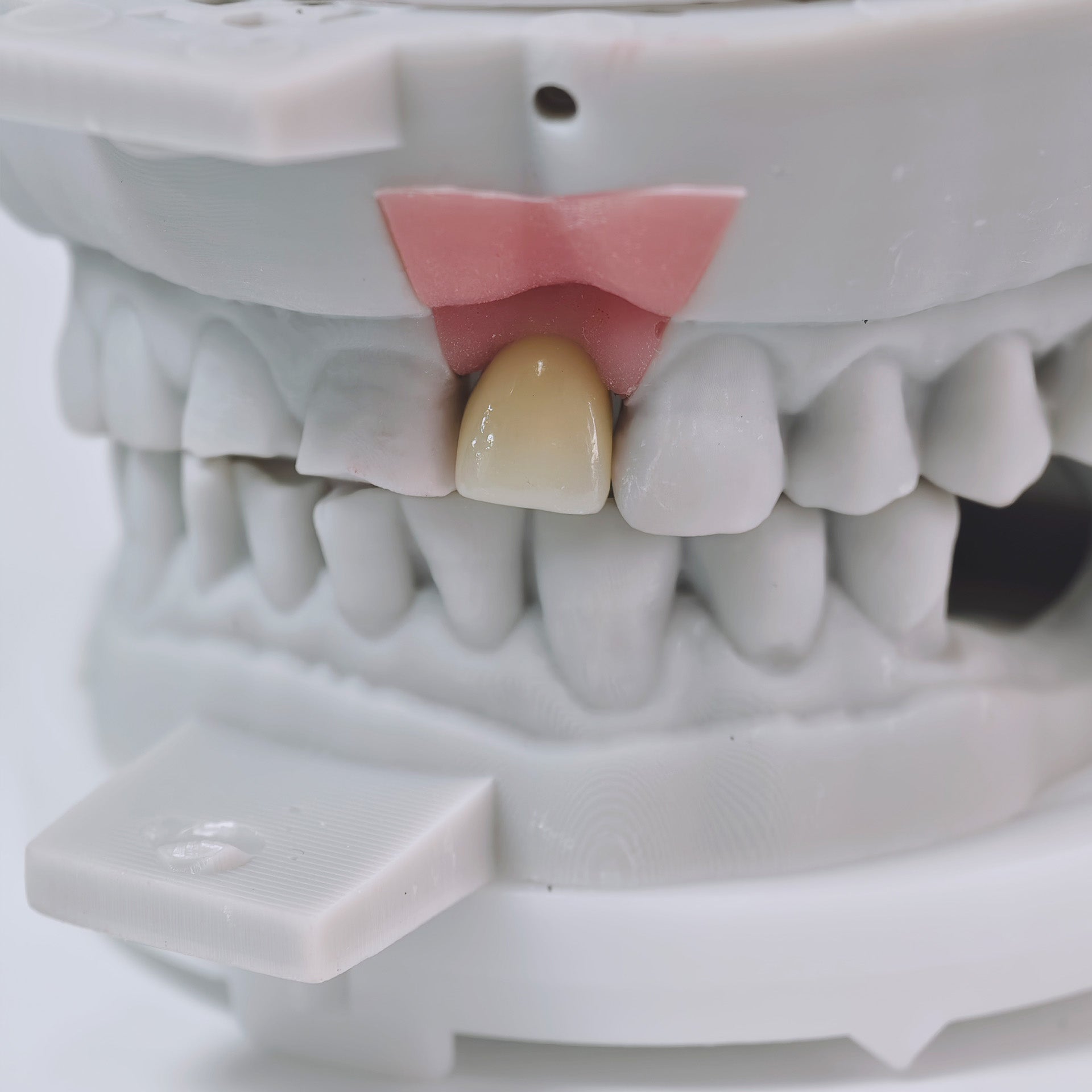 Zirconia Crown With Screw Retained