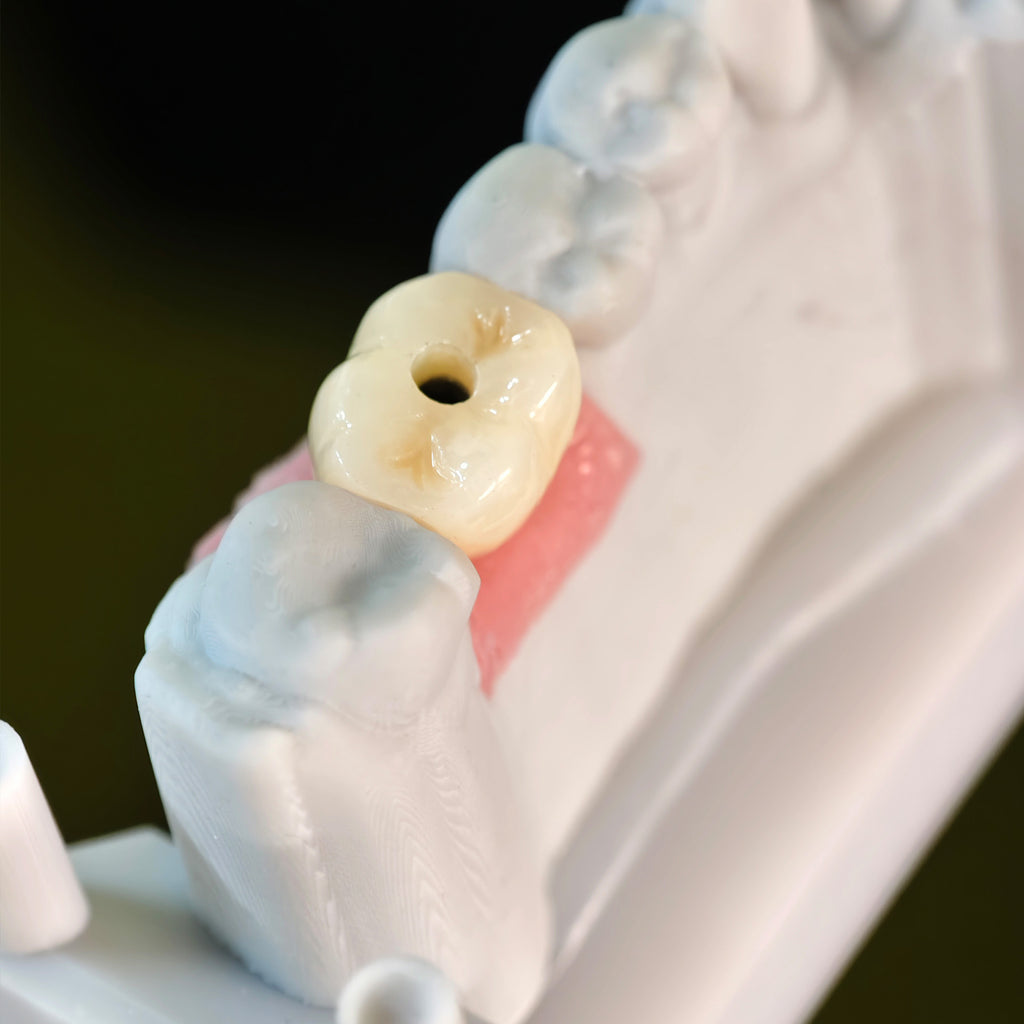 Zirconia Crown With Screw Retained