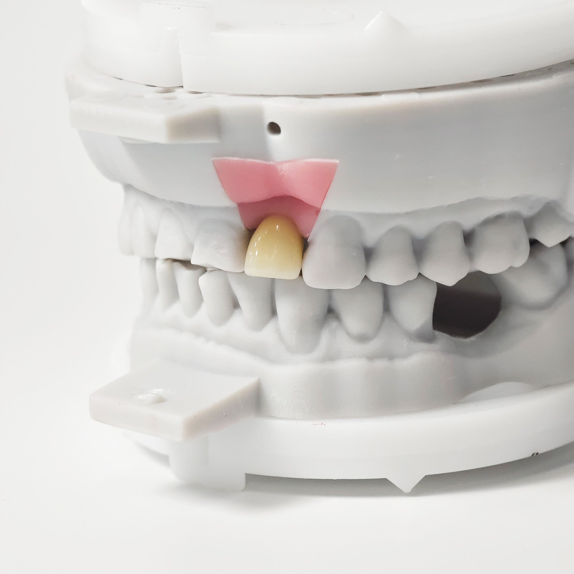 Zirconia Crown With Screw Retained
