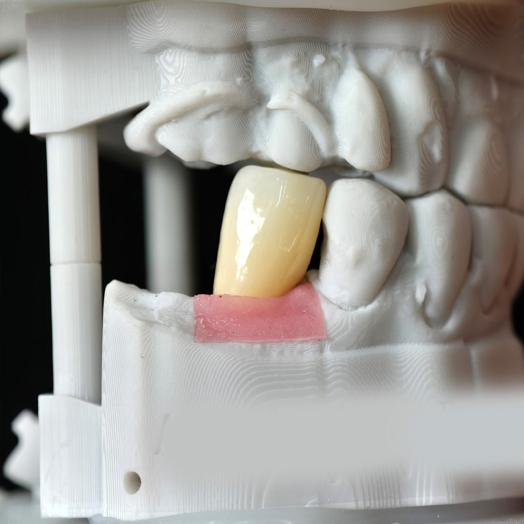 Zirconia Crown With Screw Retained