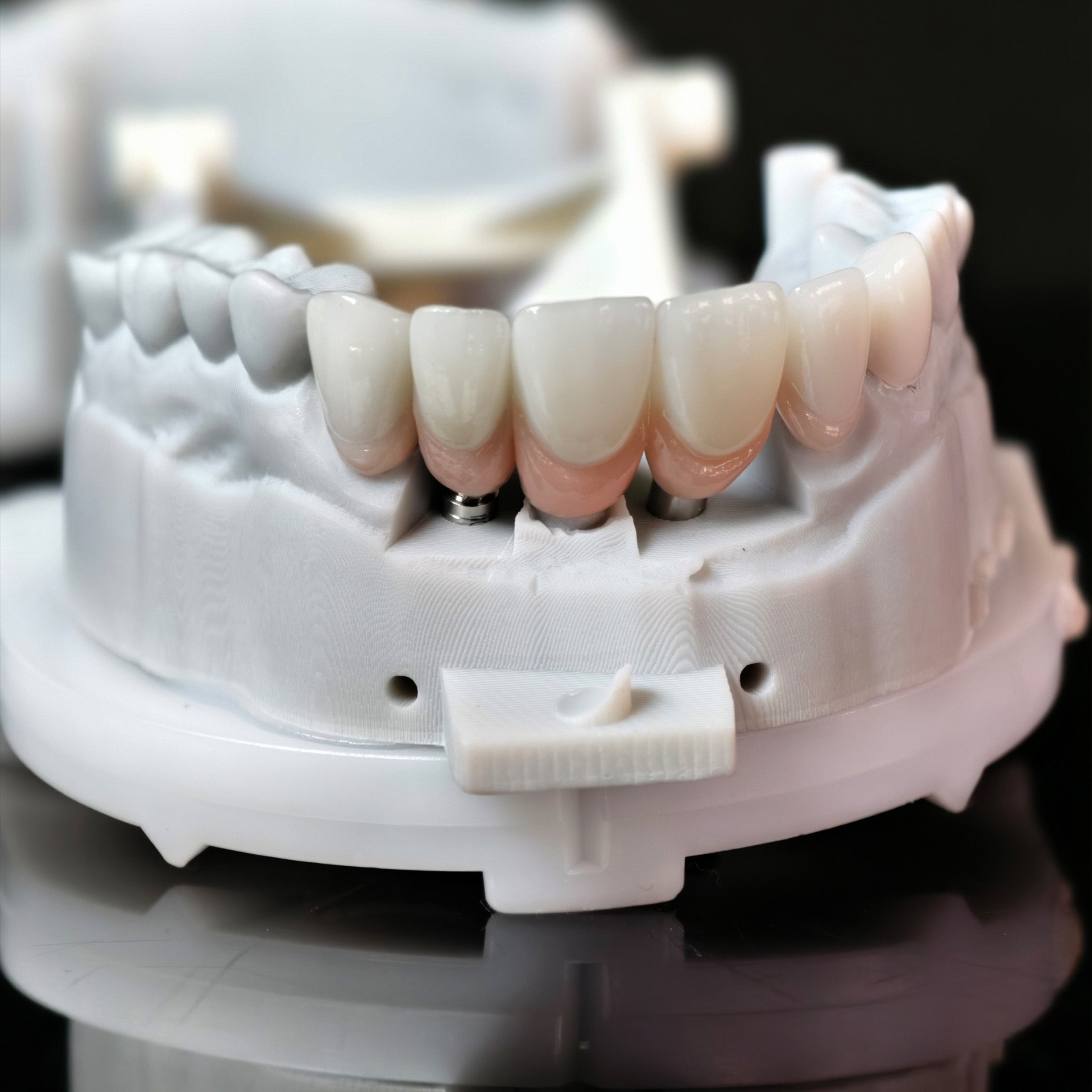 Zirconia Crown With Screw Retained And Cement Retained And Ceramic Veneers