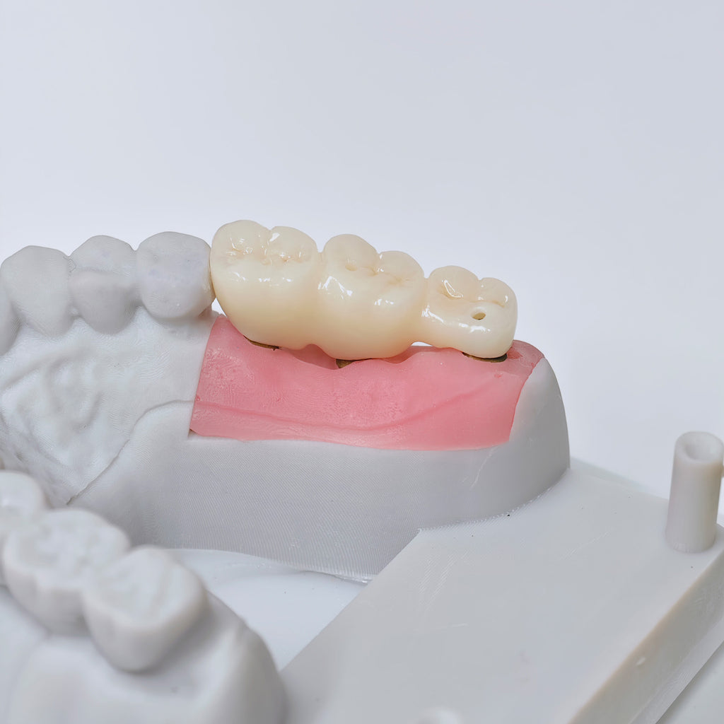 Zirconia Implant Bridge Screwmentable Dental Crown