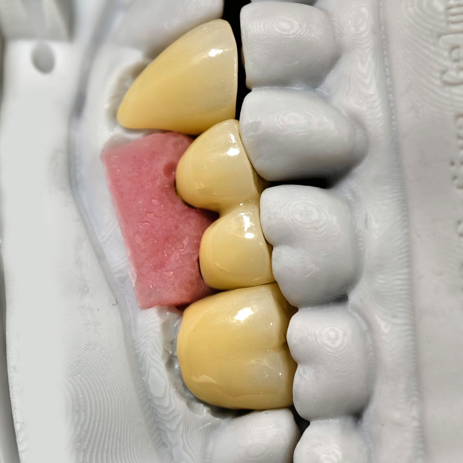 Zirconia Implant Bridge Screwmentable Dental Crown