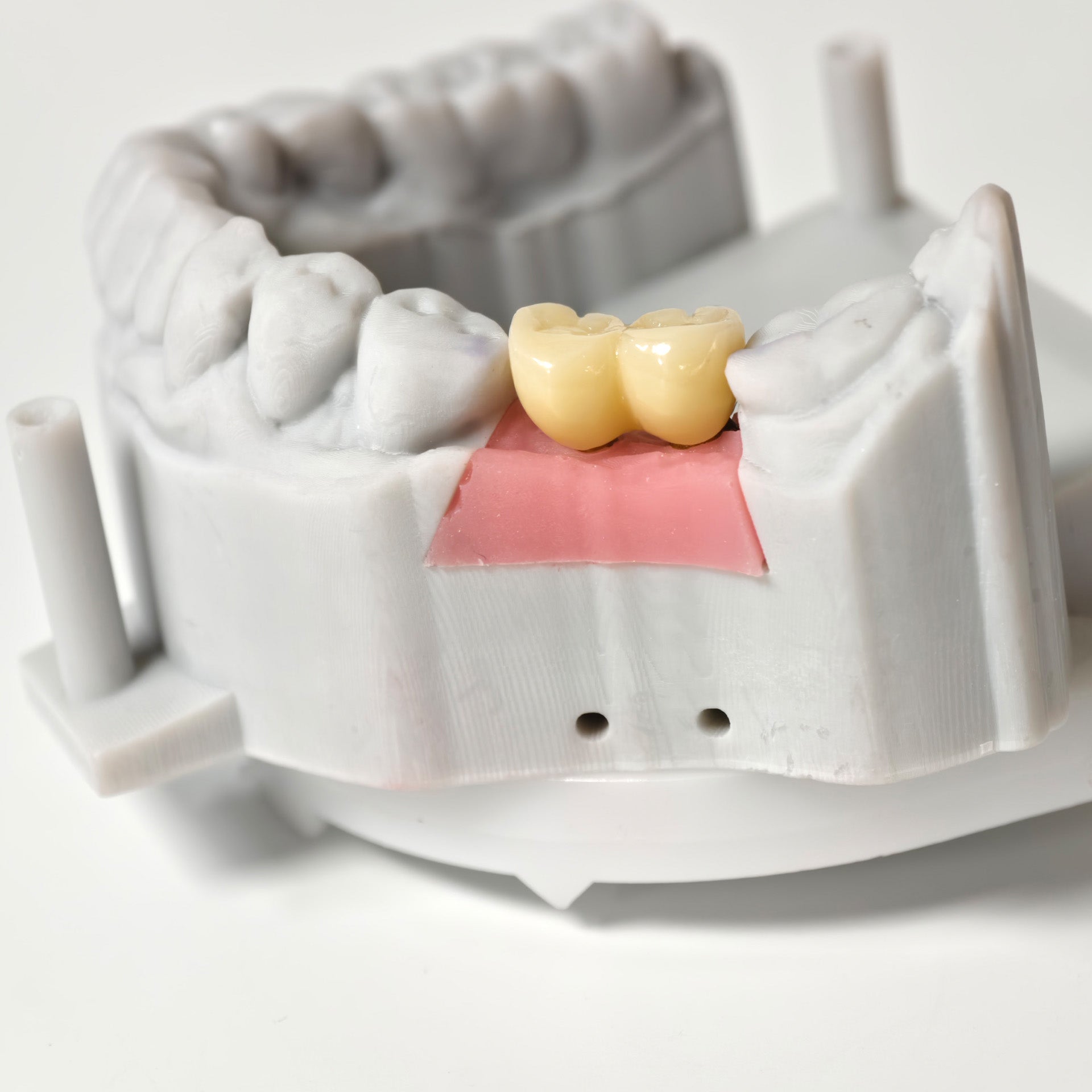 Zirconia Implant Bridge Screwmentable Dental Crown