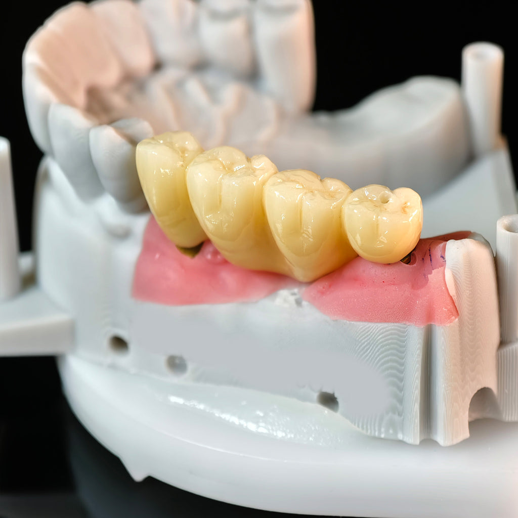 Zirconia Implant Bridge Screwmentable Dental Crown