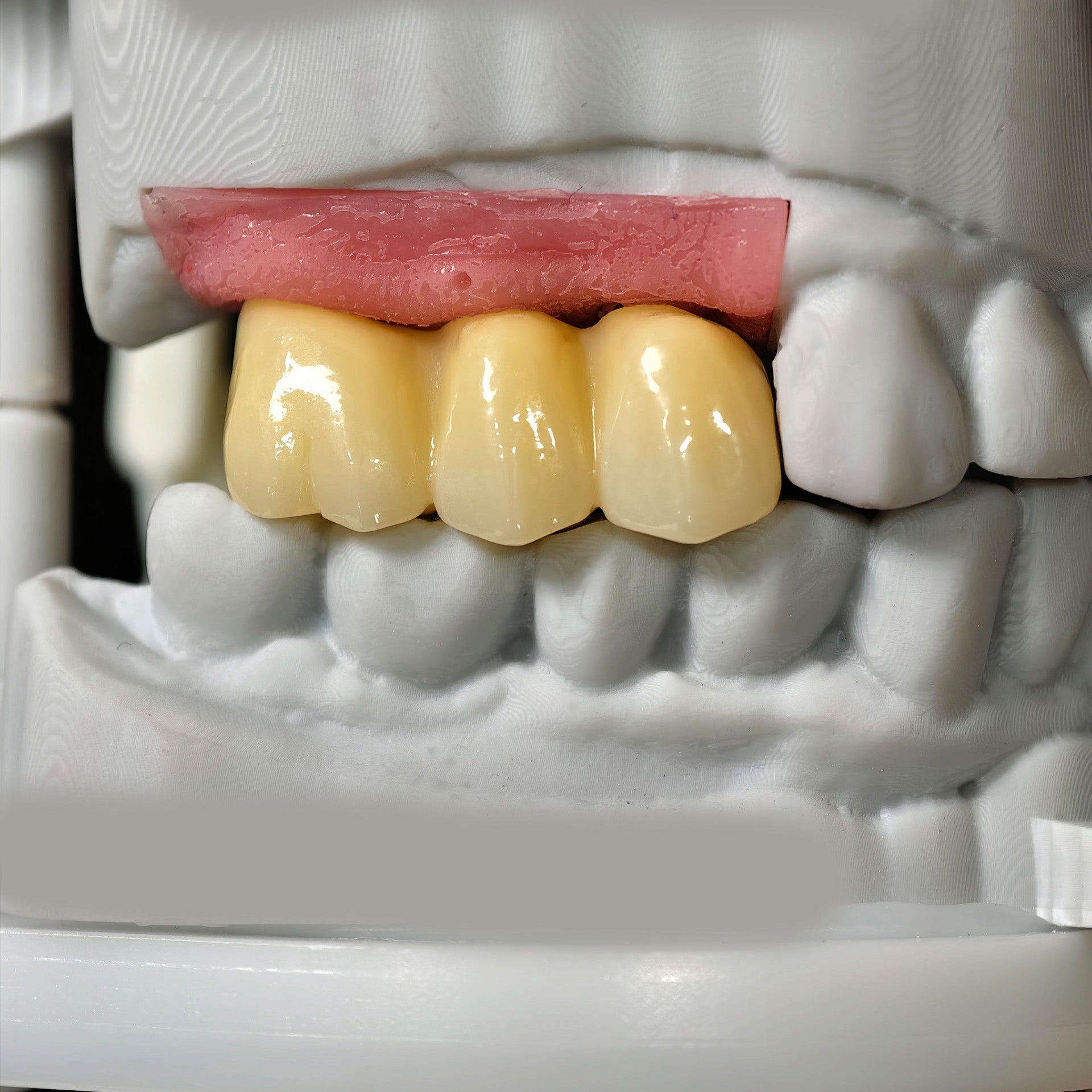 Zirconia Implant Bridge Screwmentable Dental Crown