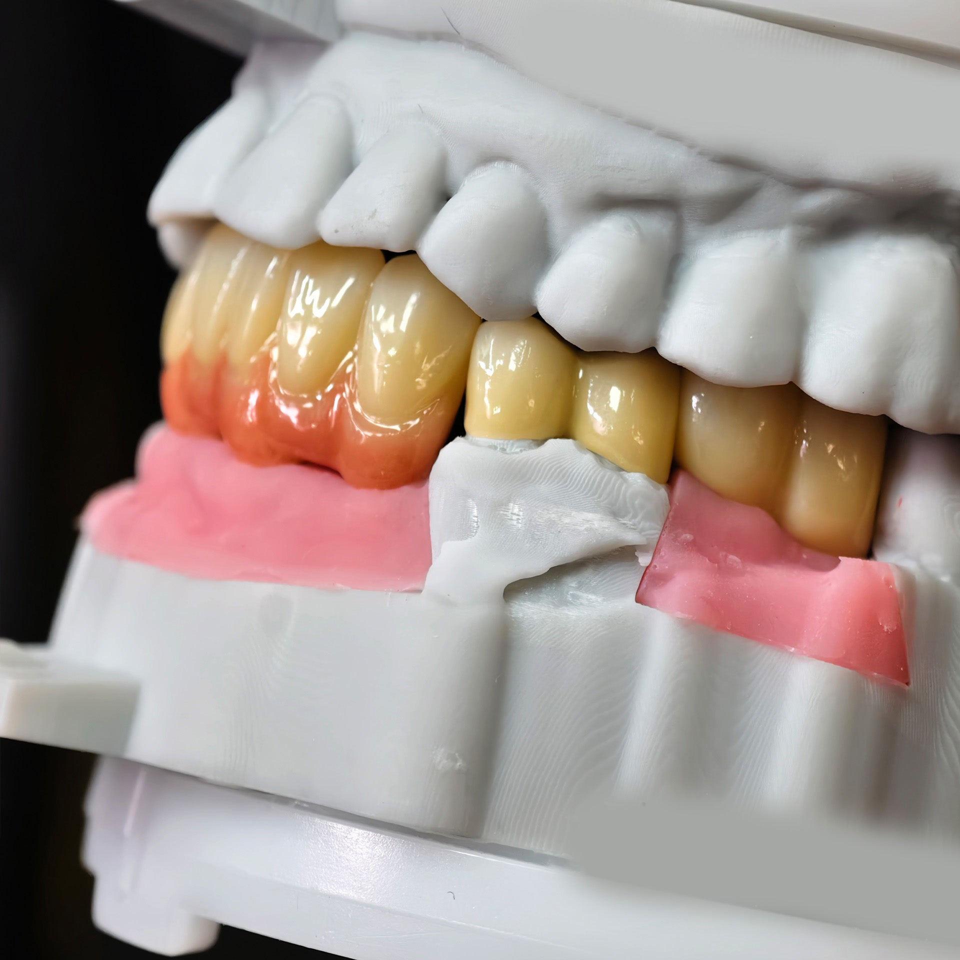 Zirconia Implant Bridge Screwmentable Dental Crown