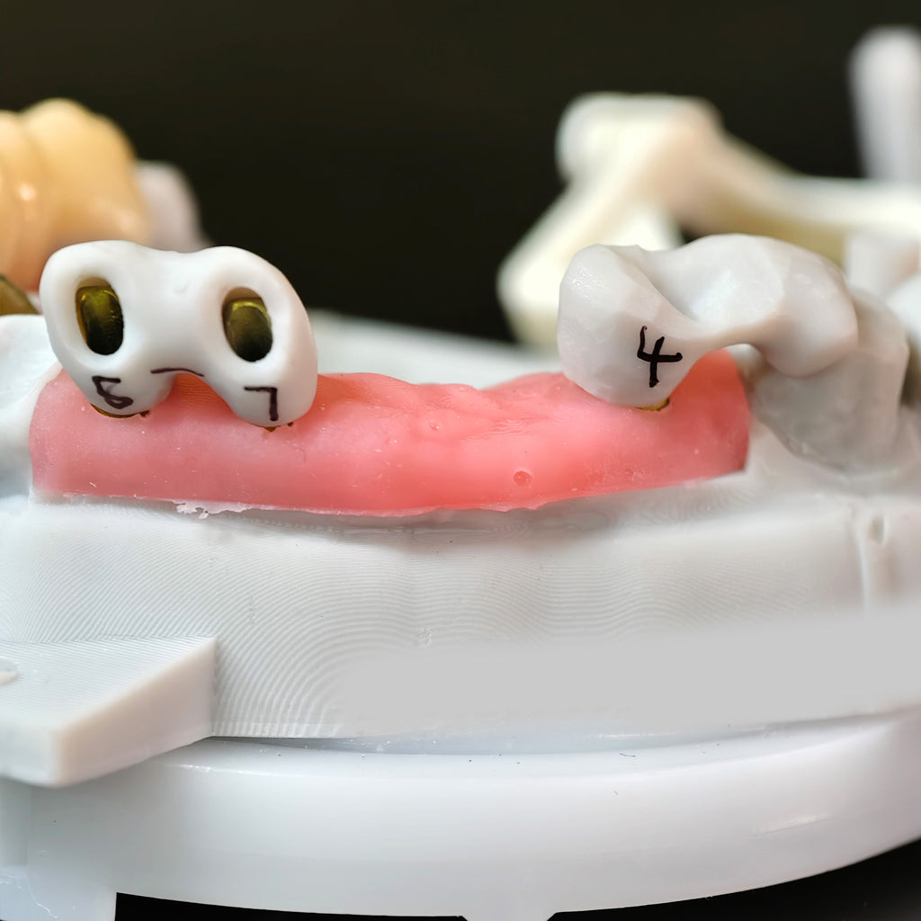 Zirconia Implant Bridge Screwmentable Dental Crown