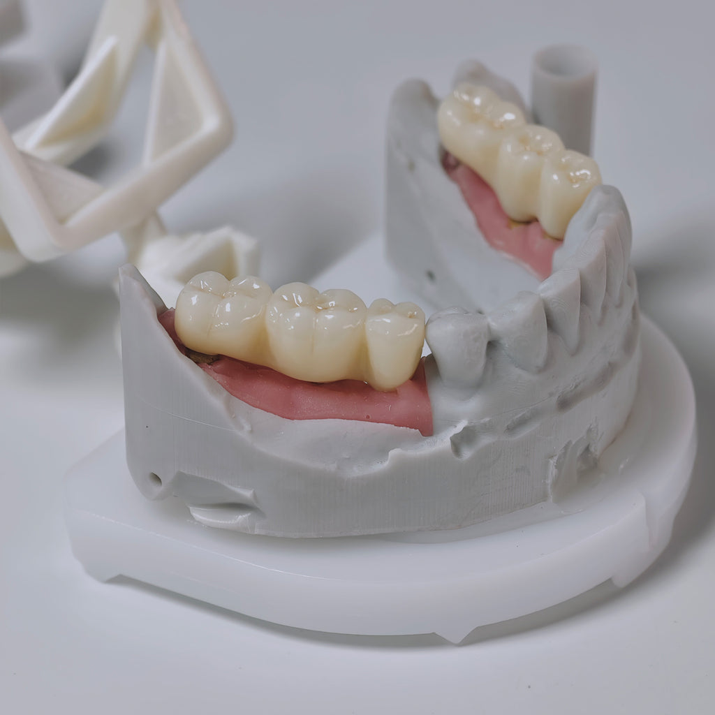 Zirconia Implant Bridges Screwmentable Dental Crown