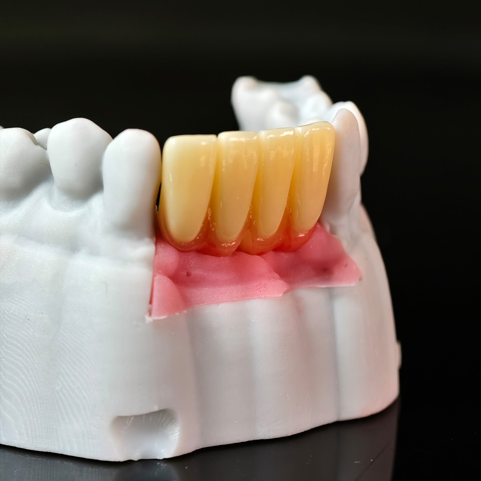 Zirconia Implant Bridge With Gold Plating