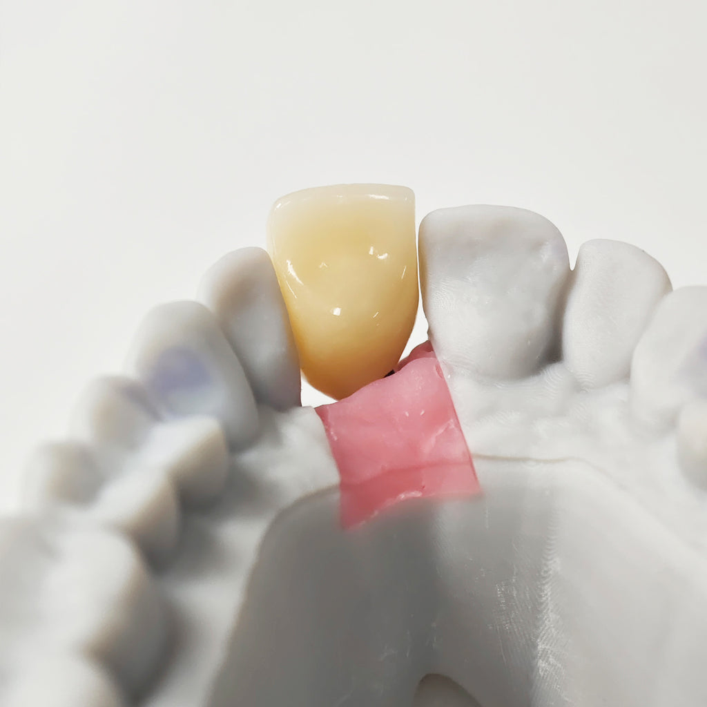 Zirconia Implant Crown Screwmentable Dental Crown