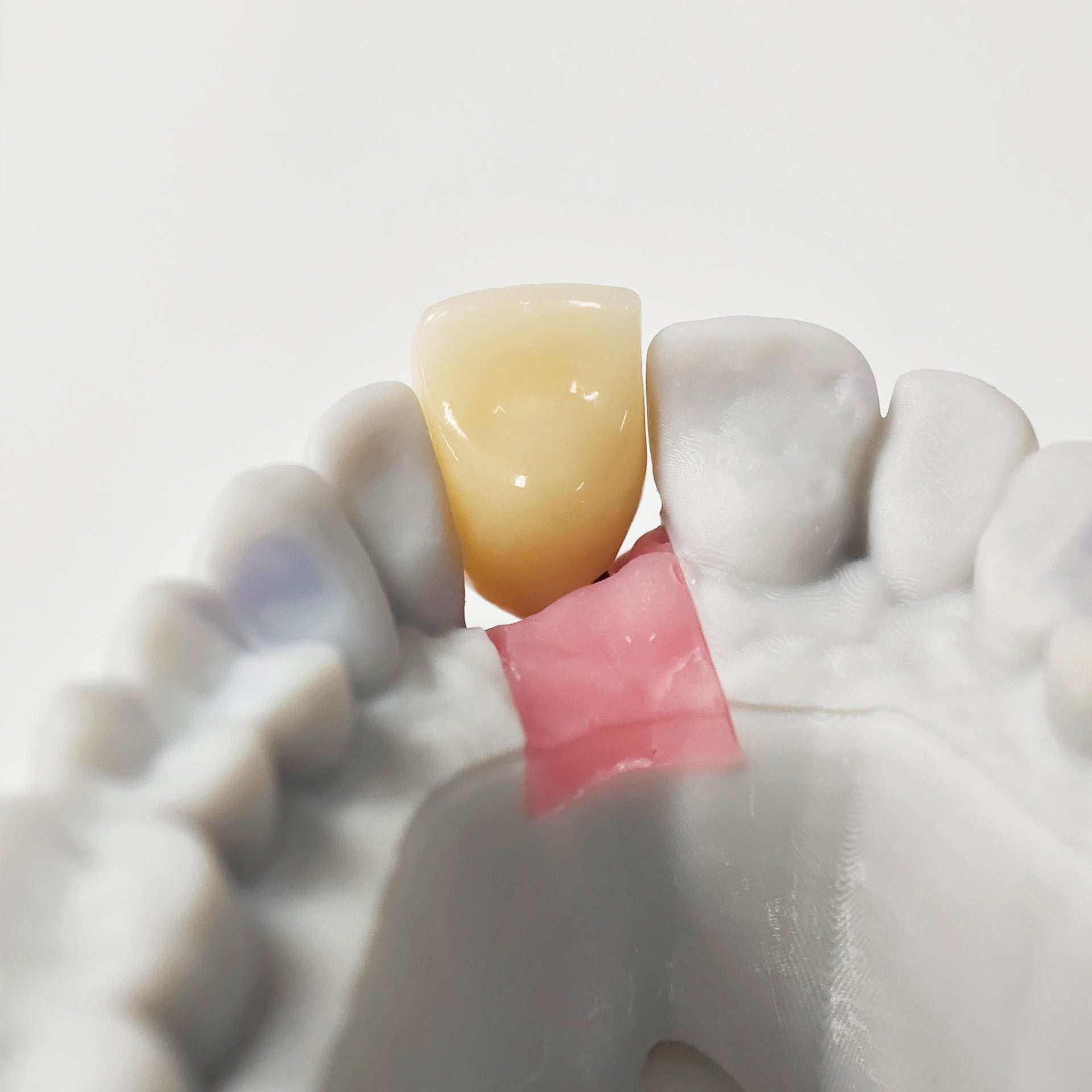 Zirconia Implant Crown Screwmentable Dental Crown