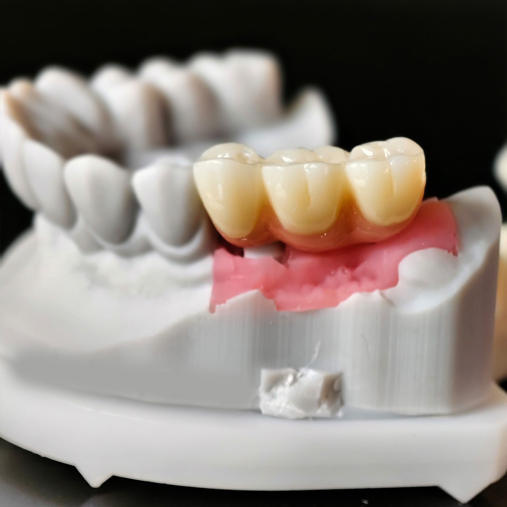 Zirconia Implant Crown Screwmentable Dental Crown