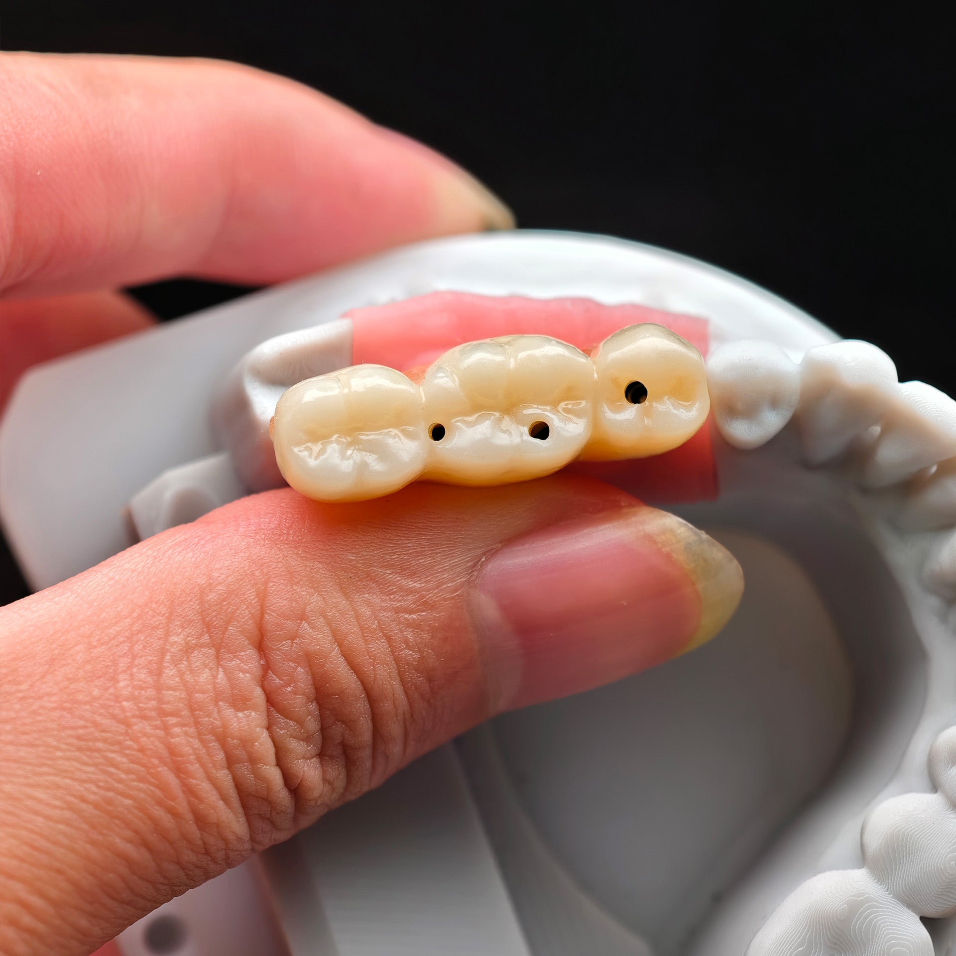 Zirconia Implant Crown Screwmentable Dental Crown