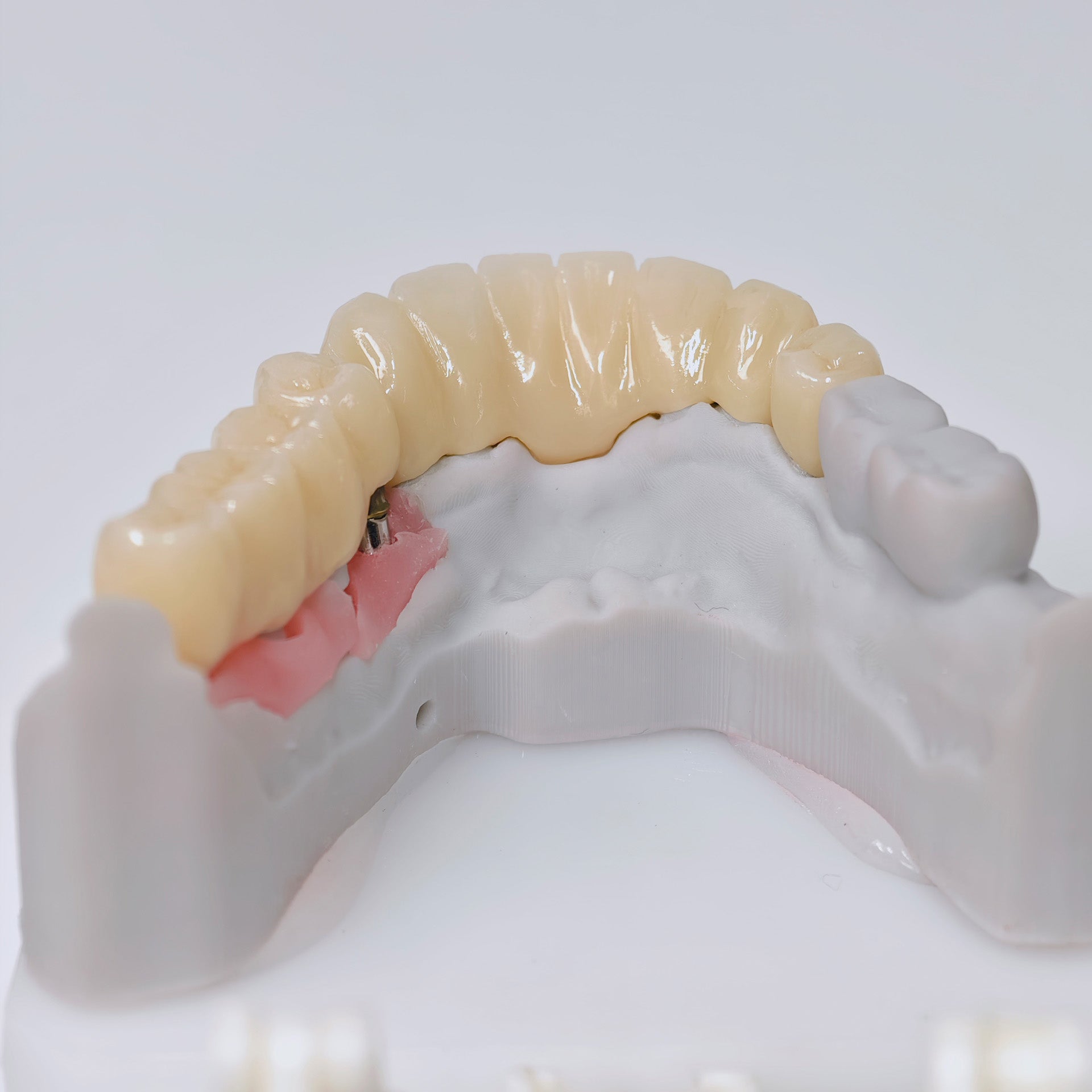 Zirconia Implant Crown And Bridges Screwmentable Dental Crown
