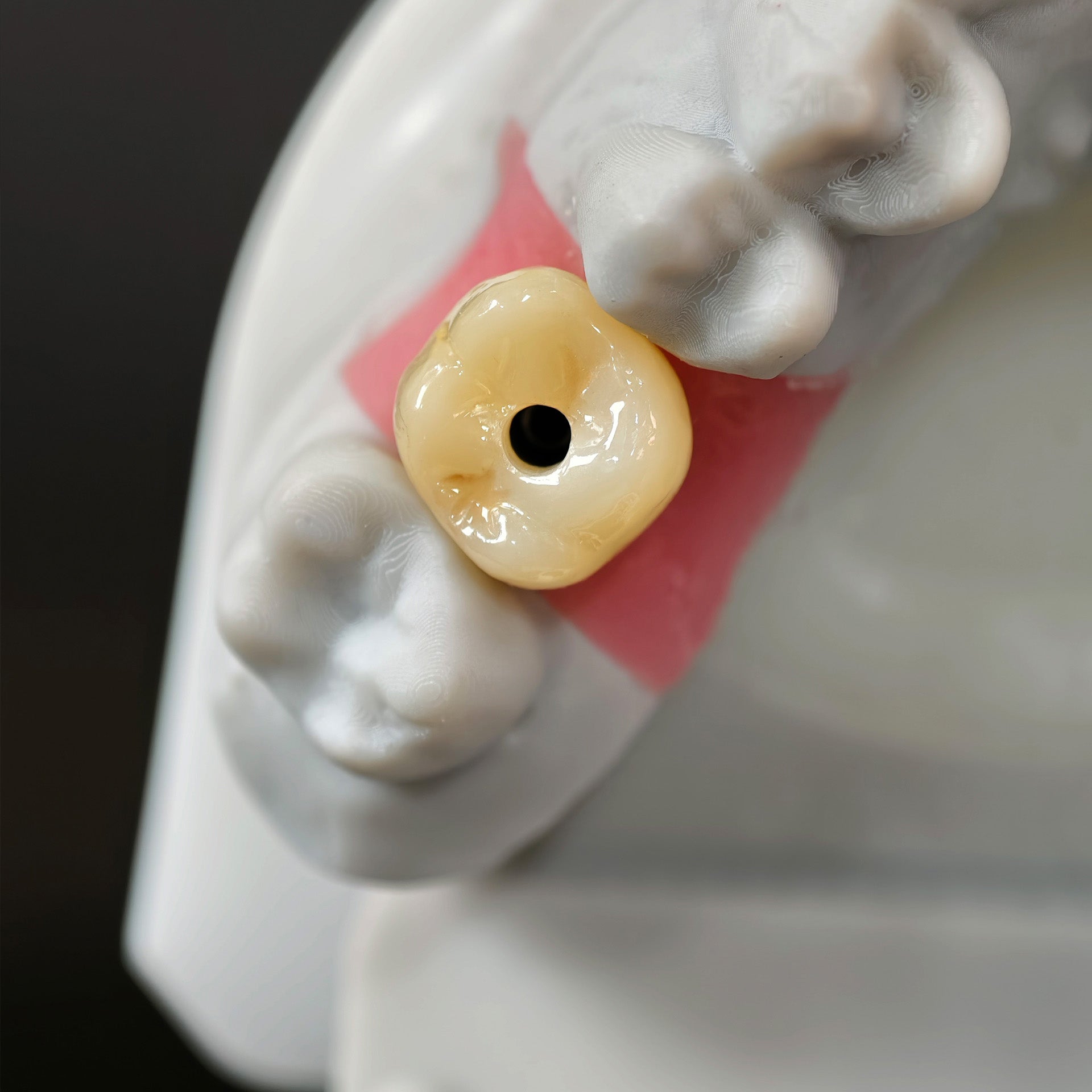 Zirconia Implant Crown With Gold Plating