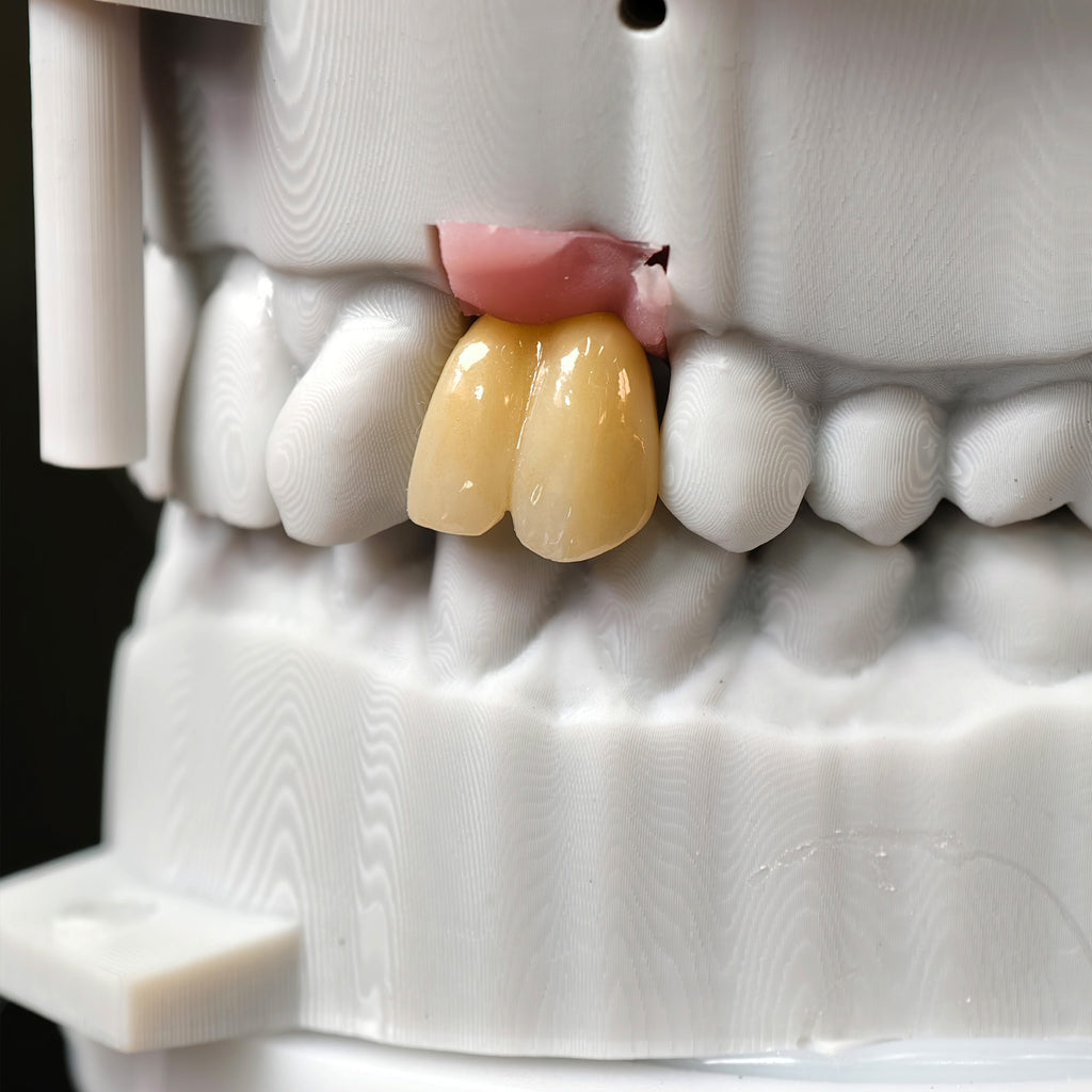 Zirconia Implant Crown With Gold Plating