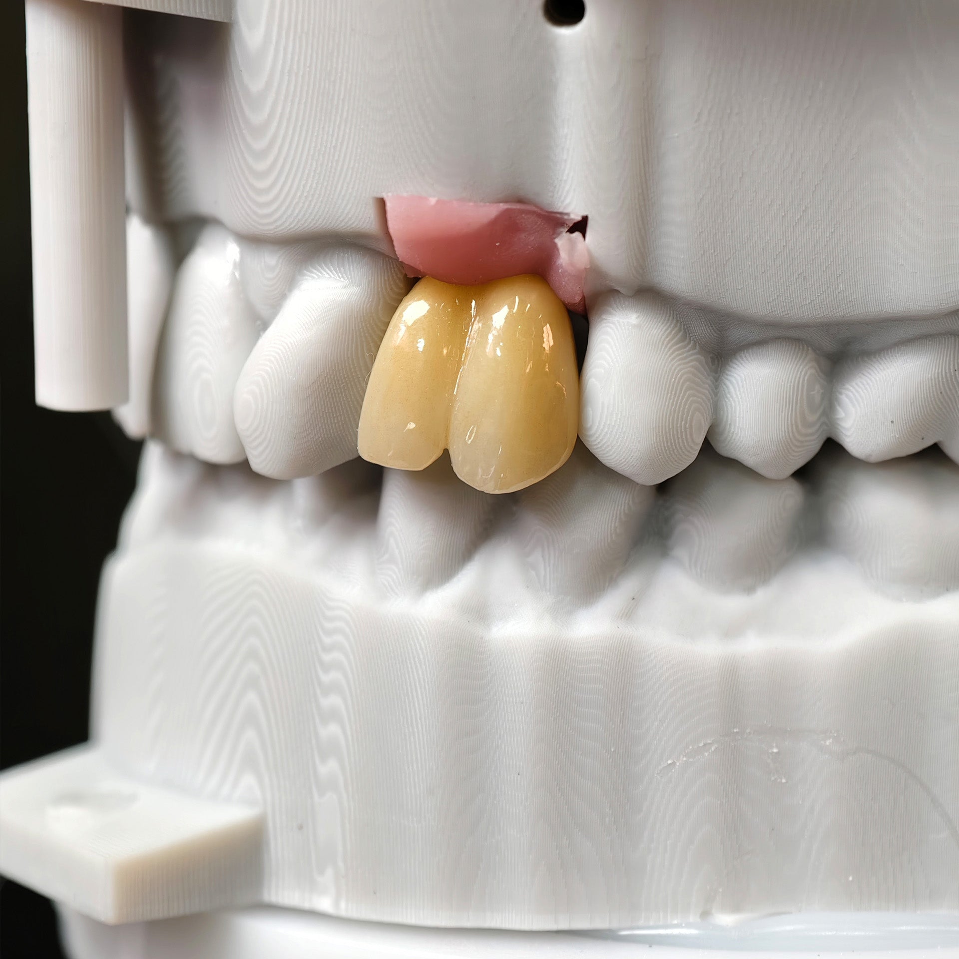 Zirconia Implant Crown With Gold Plating