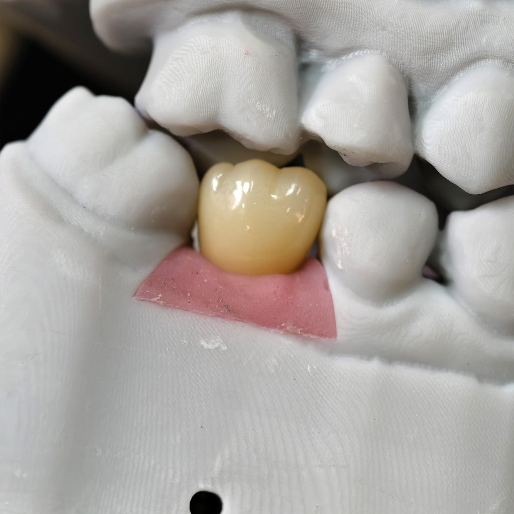 Zirconia Implant Crown With Gold Plating